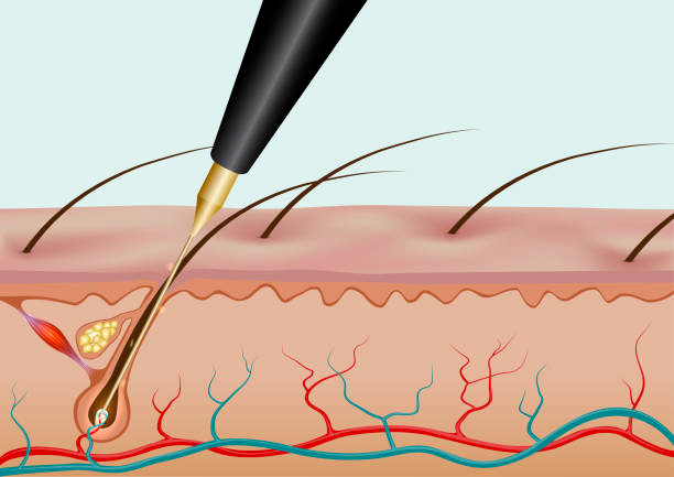 Epilation électrique définitive