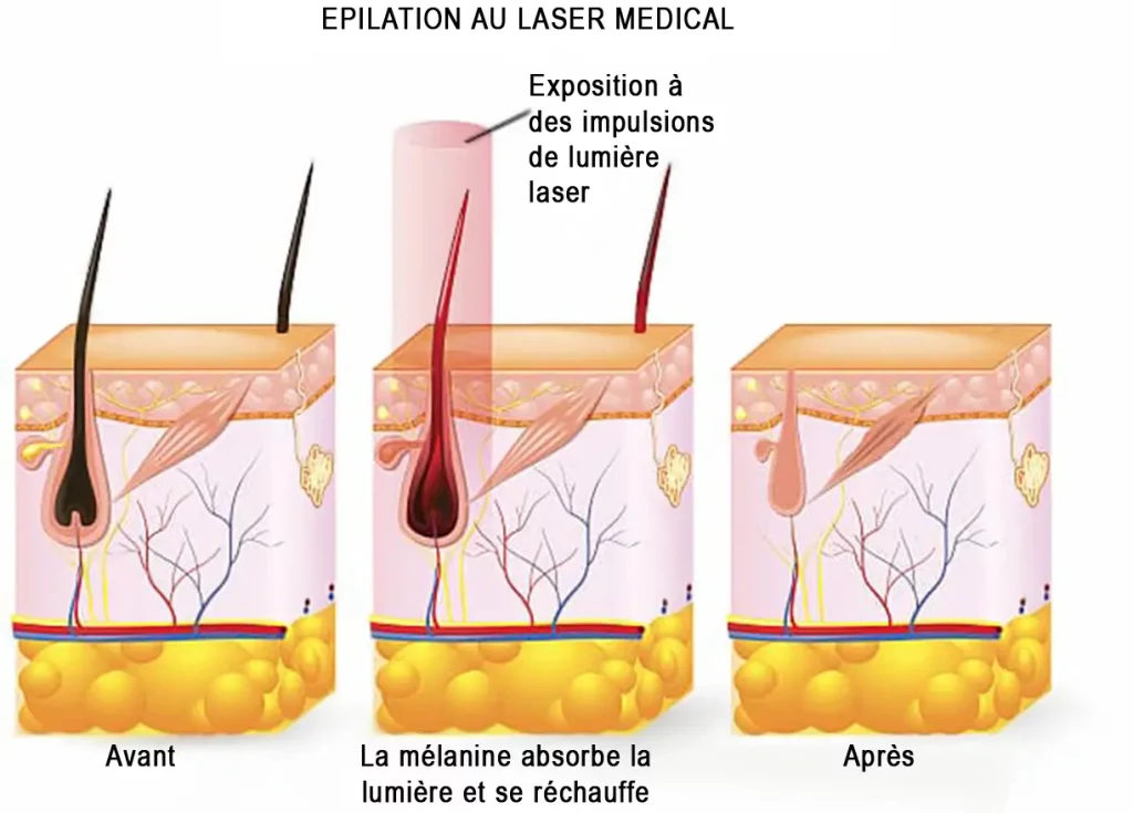 Shema expliquant le processus du fonctionnement du laser médical dans l'épilation définitive au laser