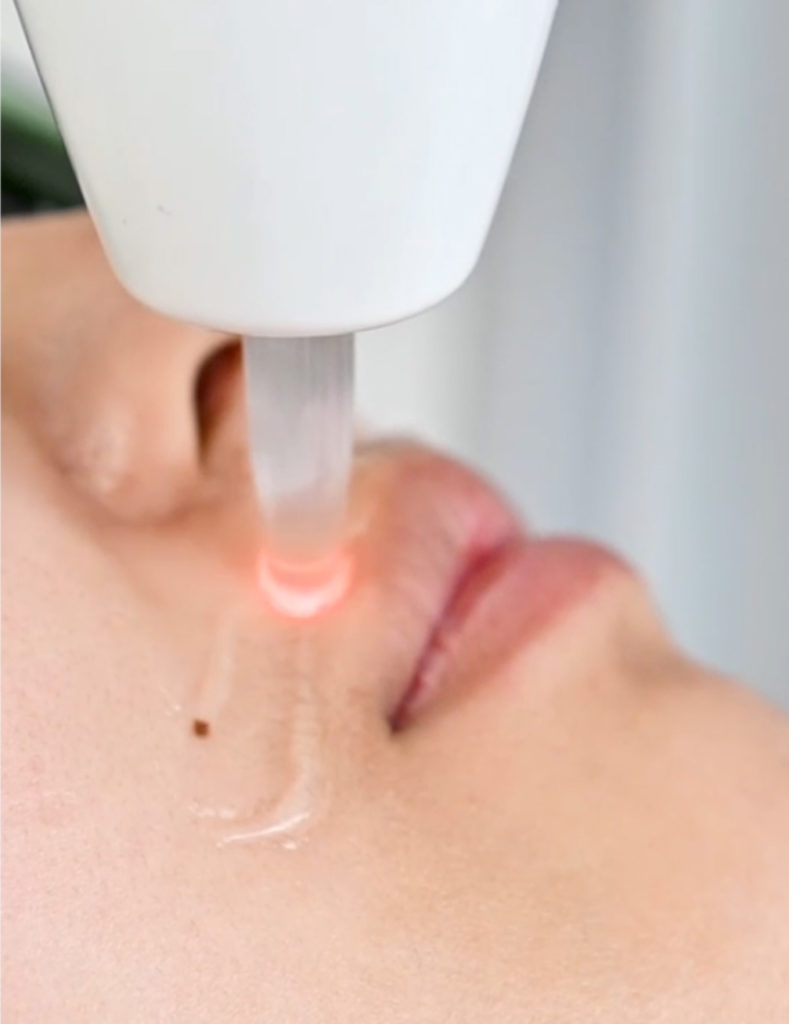 Epilation laser lèvre visage