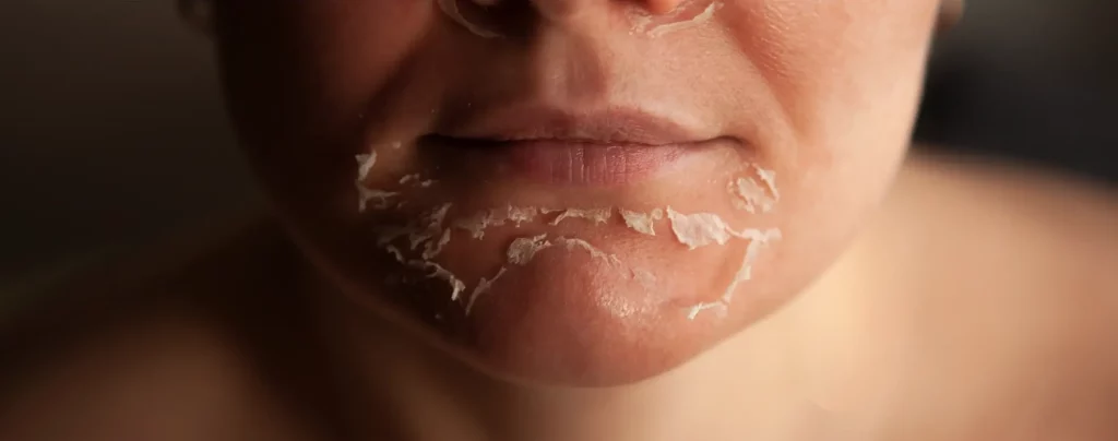 peeling exfoliation chimique